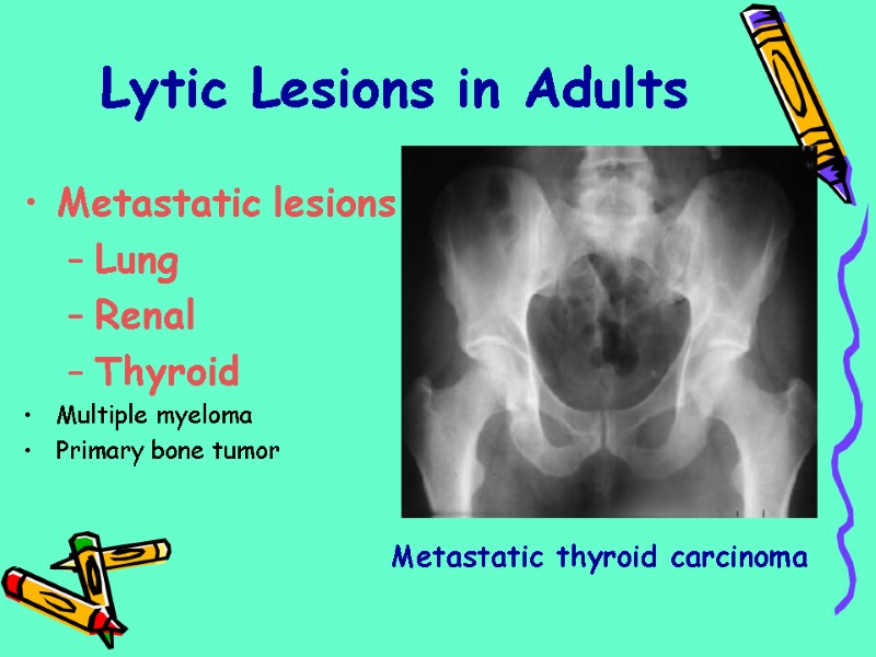 Lytic Lesions in Adults Metastatic lesions Lung Renal Thyroid Multiple myeloma Primary bone tumor